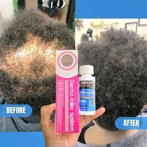 Kirkland Minoxidil 5% Hair & Derma Roller Treatment – Beard & Solution (1 Month Supply) + Dermaroller